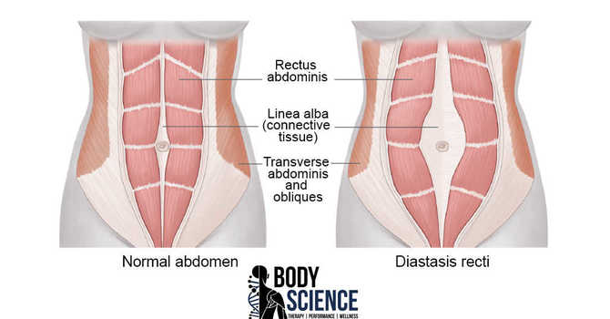 Diastasis Recti – Can Physiotherapy Or Chiropractic Help? - Body